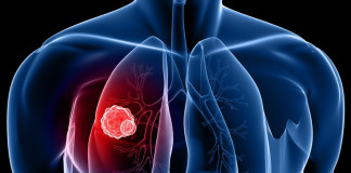 lung cancer symptoms