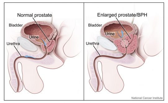 signs of prostate cancer