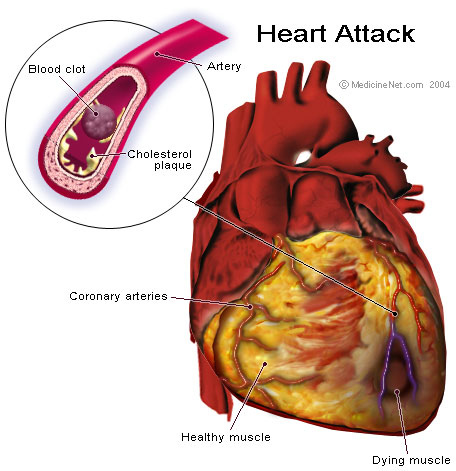 Signs of a Heart Attack Women