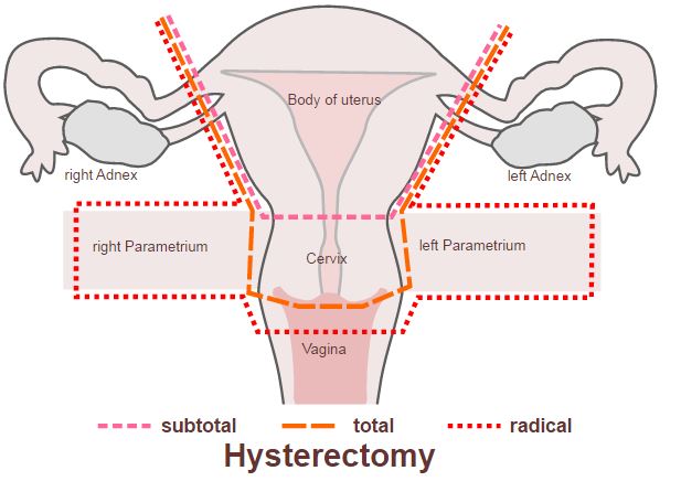 hysterectomy-endometriosis