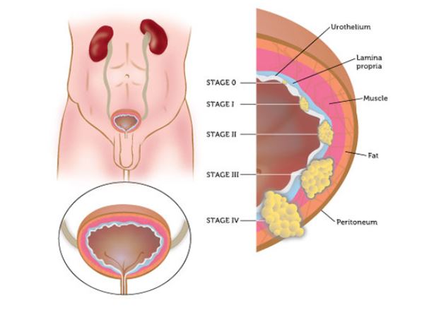 types of bladder cancer