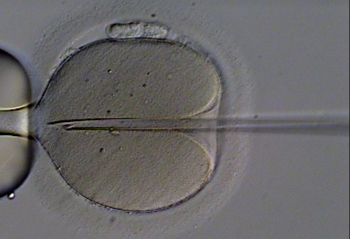 vitro fertilization - endometriosis