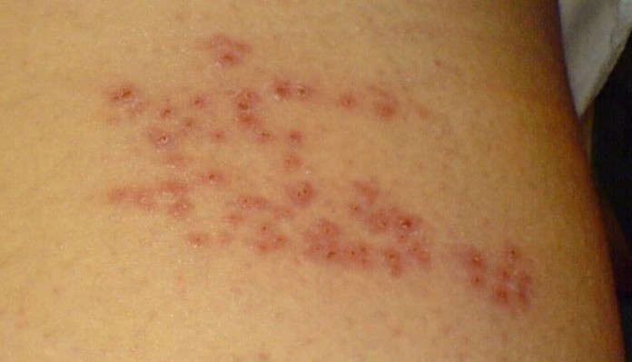 what are shingles