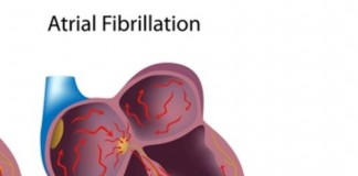 atrial fibrillation treatment