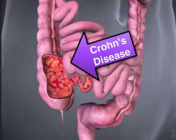 Crohn's Disease Causes