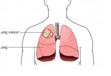 what is lung cancer- signs and symptoms