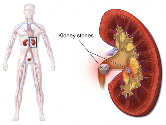Kidney Stones Symptoms