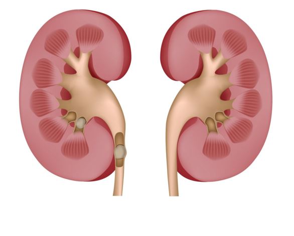 kidney stones symptoms treatment
