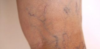 how to get rid of varicose veins