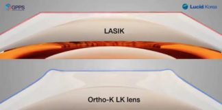 Ortho K Lenses